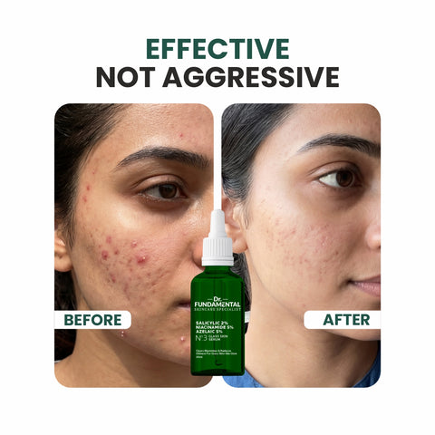 N0.2 Glass Skin Anti Acne Serum